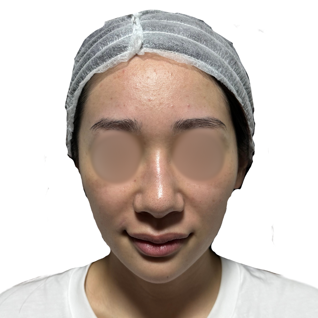 水光注射（スキンブースター）